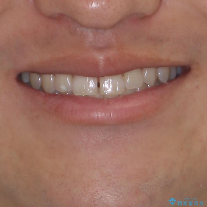 隙間の空いた前歯を治したい 上顎の部分矯正の治療前(顔貌)