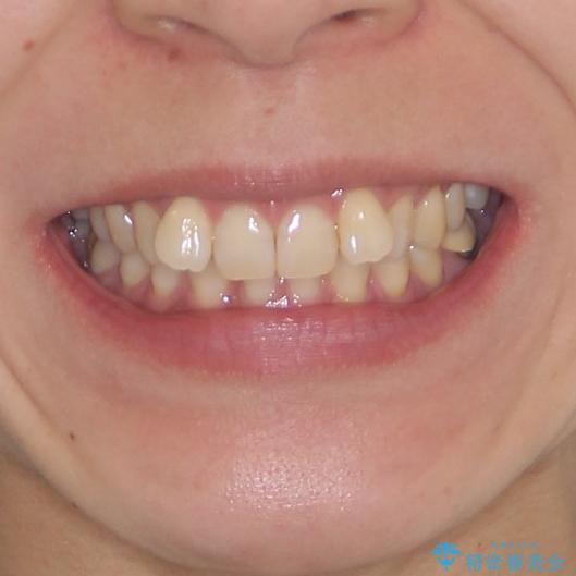 下顎2前歯の欠損 インビザラインによる抜歯矯正の治療前(顔貌)