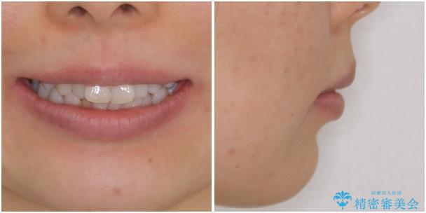 インビザラインが続けられない ワイヤー装置による抜歯矯正の治療前(顔貌)
