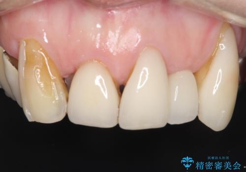 ラミネートベニアがかけた。オールセラミッククラウンで修復の治療前