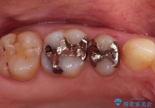 【メタルフリー】オールセラミッククラウンの症例 治療前