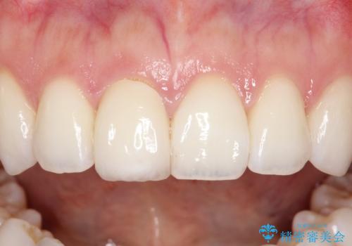 【オールセラミッククラウン】前歯の被せ物の治療前
