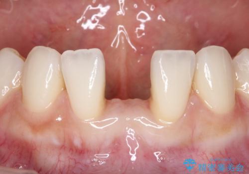 【接着ブリッジ】なるべく歯を削りたくない人への症例 治療前