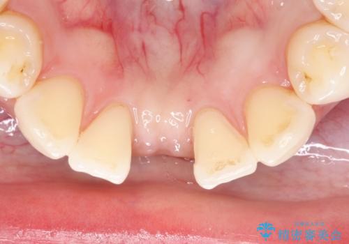 【接着ブリッジ】なるべく歯を削りたくない人への治療中