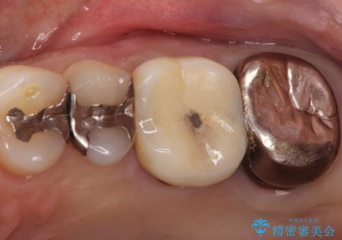 【再根管治療】オールセラミッククラウンによる修復の治療前