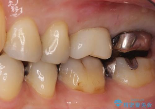 【再根管治療】オールセラミッククラウンによる修復の治療前