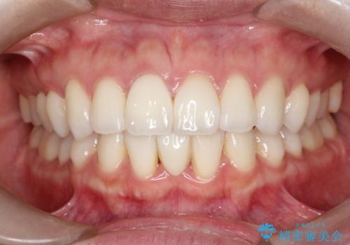 【オールセラミッククラウン】前歯の被せ物の症例 治療後