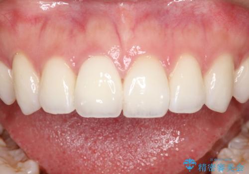 【オールセラミッククラウン】前歯の被せ物の治療後