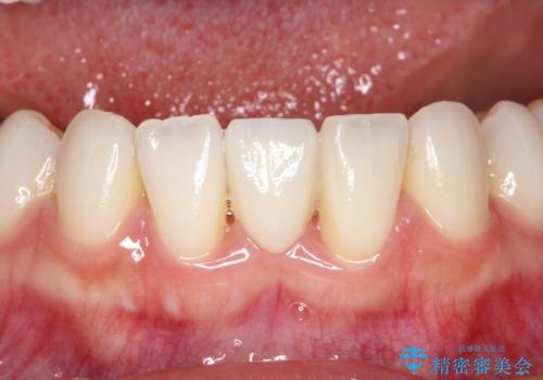 【接着ブリッジ】なるべく歯を削りたくない人への症例 治療後