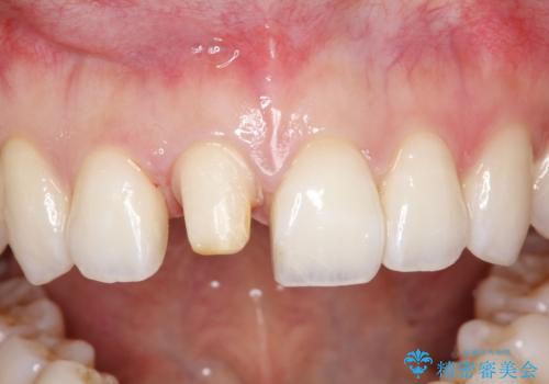 【オールセラミッククラウン】前歯の被せ物の治療中