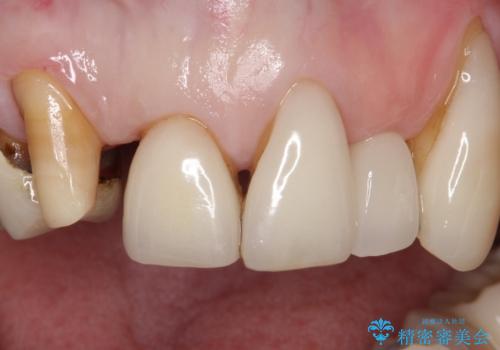 ラミネートベニアがかけた。オールセラミッククラウンで修復の治療中