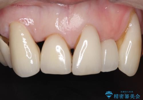 ラミネートベニアがかけた。オールセラミッククラウンで修復の治療後
