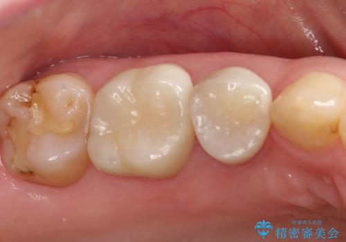 【メタルフリー】オールセラミッククラウン