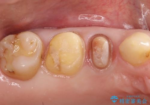【メタルフリー】オールセラミッククラウンの治療中