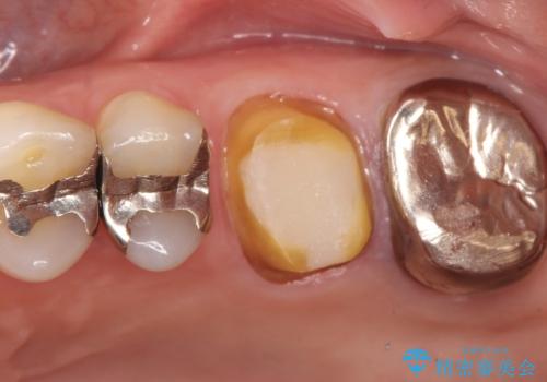 【再根管治療】オールセラミッククラウンによる修復の治療中