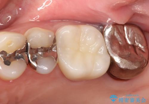 【再根管治療】オールセラミッククラウンによる修復の治療後