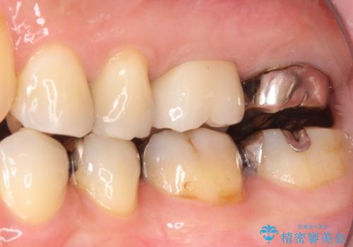 【再根管治療】オールセラミッククラウンによる修復の治療後