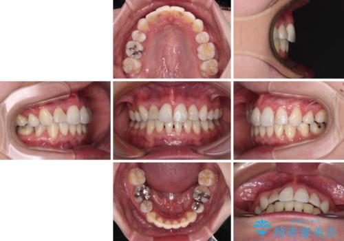 目立たないハーフリンガル矯正 抜歯矯正で口元を改善の治療後