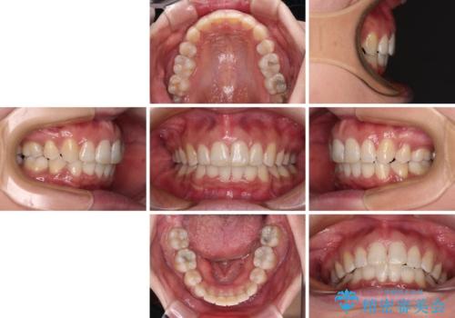 インビザラインが続けられない ワイヤー装置による抜歯矯正の治療後