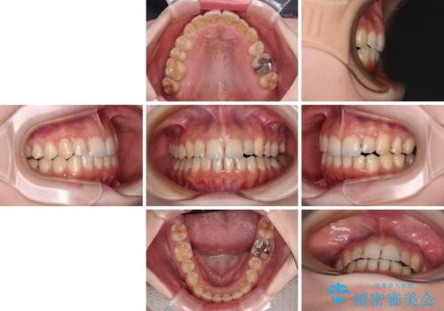 顕著な八重歯をインビザラインで治せるところまで改善の治療後