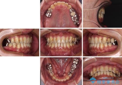 前歯の反対咬合をワイヤー矯正で改善して噛みやすくの治療後