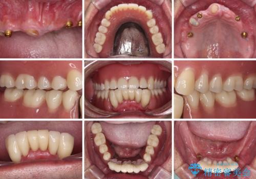 どこで咬んでいいのか分からない インプラント・オーバーデンチャーによる補綴治療の治療後