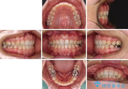 膨らんだ口元が気になる　ワイヤー装置による抜歯矯正の治療後