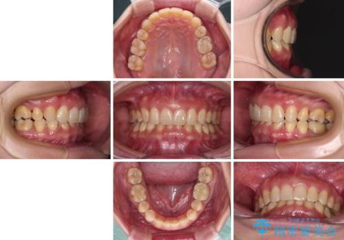 下顎2前歯の欠損 インビザラインによる抜歯矯正の治療後