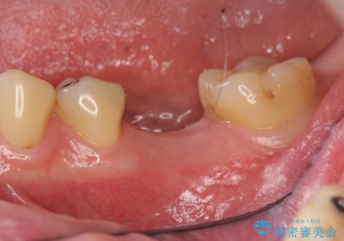 銀歯下の虫歯再発 インプラントによる機能回復の治療中