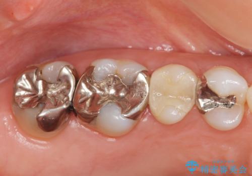 噛み心地の良いゴールドインレー修復の治療前