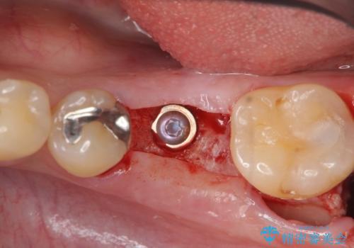 銀歯下の虫歯再発 インプラントによる機能回復の治療中