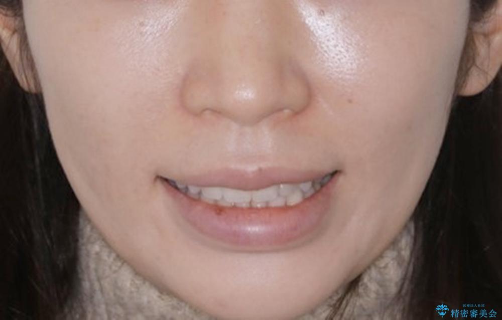 部分矯正とインビザラインを組み合わせて短期間での矯正治療の治療後(顔貌)