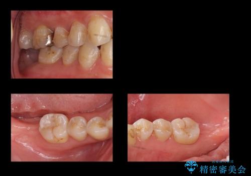 奥歯の歯ぐきからウミが出る 抜歯してインプラントへの治療中