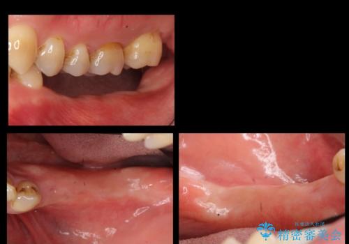 奥歯のインプラント 大人になって残っていた乳歯がダメになったの治療中