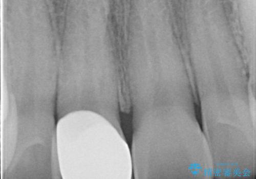 【オールセラミッククラウン】前歯の被せ物の治療後