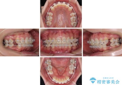 インビザラインが続けられない ワイヤー装置による抜歯矯正の治療中