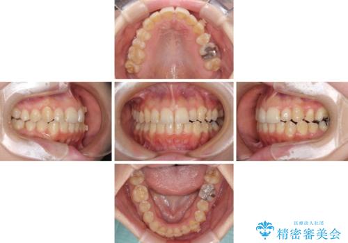 顕著な八重歯をインビザラインで治せるところまで改善の治療中