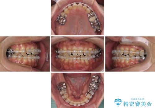 前歯の反対咬合をワイヤー矯正で改善して噛みやすくの治療中