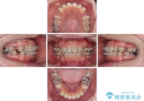 膨らんだ口元が気になる　ワイヤー装置による抜歯矯正の治療中