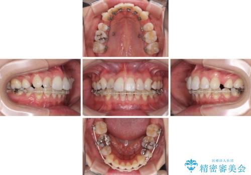 目立たないハーフリンガル矯正 抜歯矯正で口元を改善の治療中