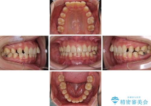 下顎2前歯の欠損 インビザラインによる抜歯矯正の治療中