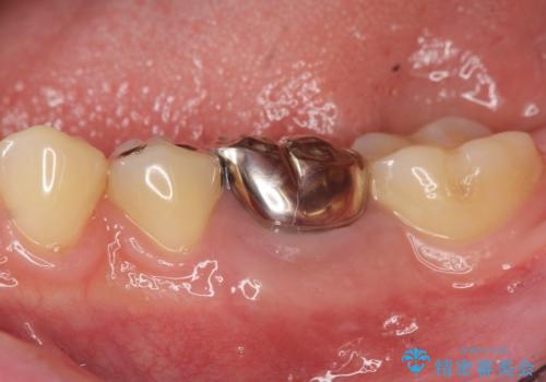 銀歯下の虫歯再発　インプラントによる機能回復の症例 治療前