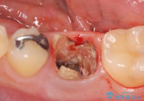 銀歯下の虫歯再発 インプラントによる機能回復の治療前