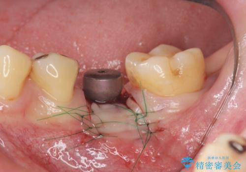 銀歯下の虫歯再発 インプラントによる機能回復の治療中