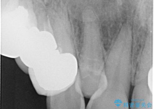 ラミネートベニアがかけた。オールセラミッククラウンで修復の治療前