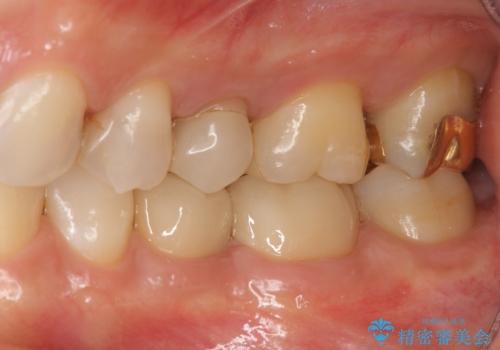 検診で判明した虫歯の再発の治療後