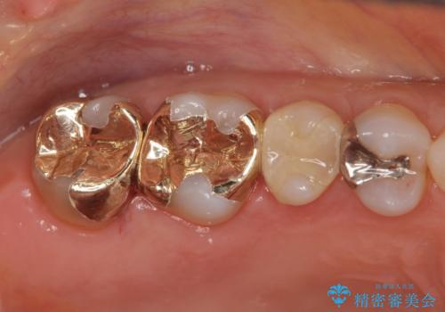 噛み心地の良いゴールドインレー修復の治療後