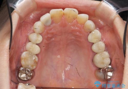 [ セラミック・インプラント全顎治療 ]  長年悩まされている歯の治療にケリをつけたいの治療前