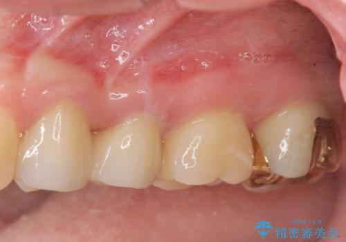 放置された虫歯　小矯正+歯周外科による保存処置の症例 治療後