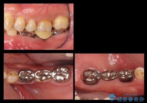 奥歯のインプラント　大人になって残っていた乳歯がダメになったの症例 治療前